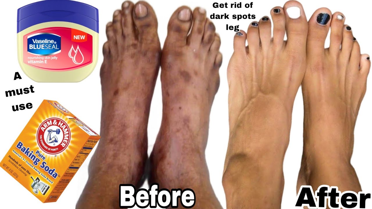 2 Way I Cleared My Leg Wrinkles & Damage leg | To Get clear brighter smooth younger looking soft leg