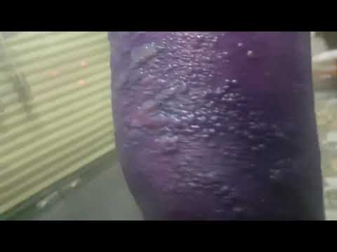 Thuốc Trị Giời Leo zona