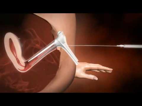 3d animation of how iui works