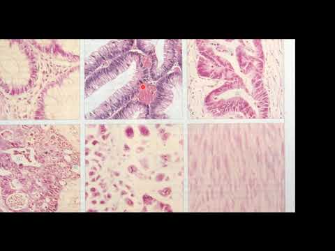 Definiciones, nomenclatura  Características de las neoplasias benignas y malignas  Diferenciación y