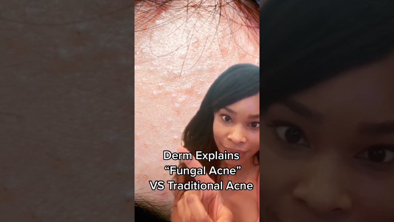 Apa Itu Fungal Acne Friendly Apa Itu Fungal Acne Friendly