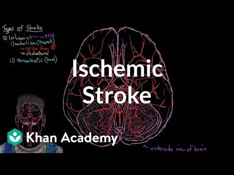 Ischemic stroke | Circulatory System and Disease | NCLEX-RN | Khan Academy