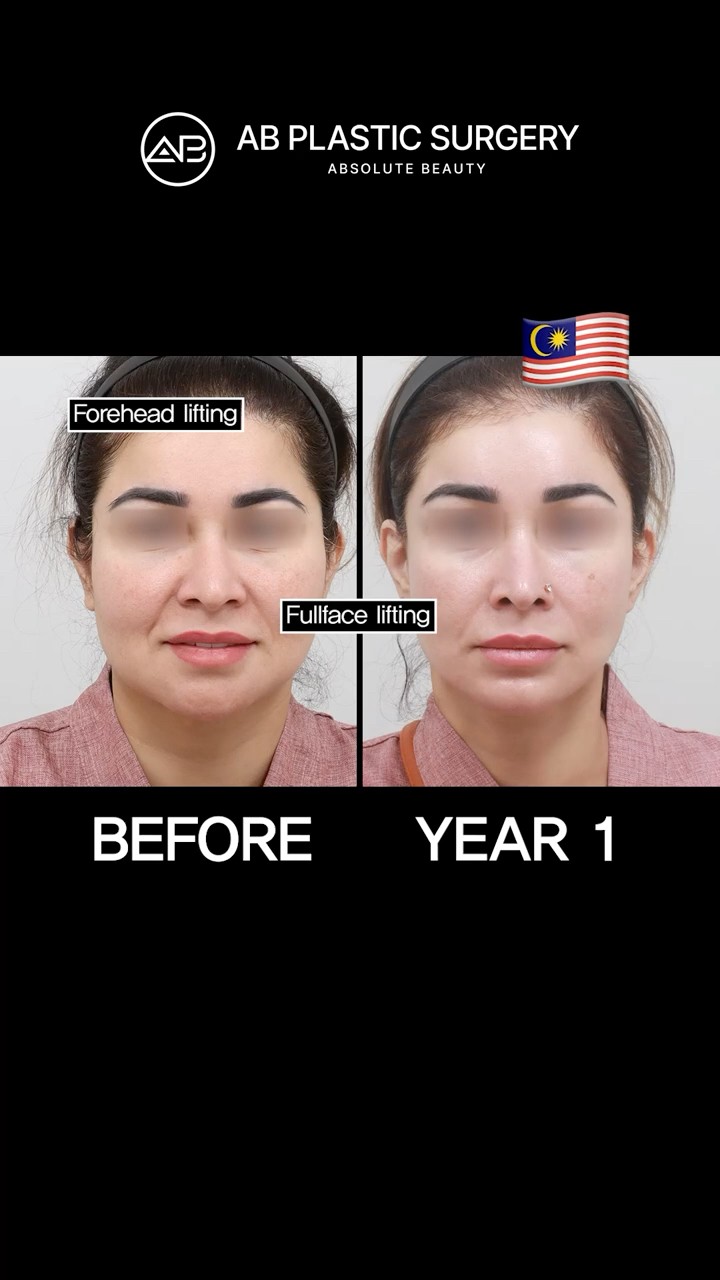 One Year After My Facelift in Korea