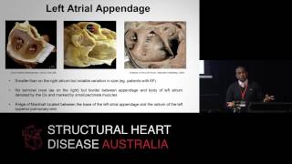Left atrial anatomy – All the nooks & crannies – Dr Sean Lal
