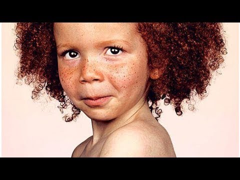 La bruna da occhi azzurri con lentiggini Il pigmentary il posto si è oscurato