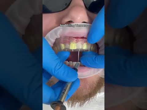 Predesigned composite veneers technique #dentist #shorts