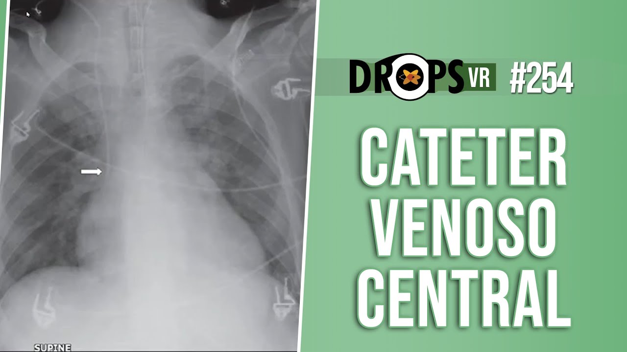 CATETER VENOSO CENTRAL - COMO VER NA RADIOGRAFIA?
