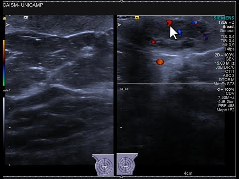 Nódulo indistinto e discreta assimetria na papila. Possível carcinoma lobular invasivo