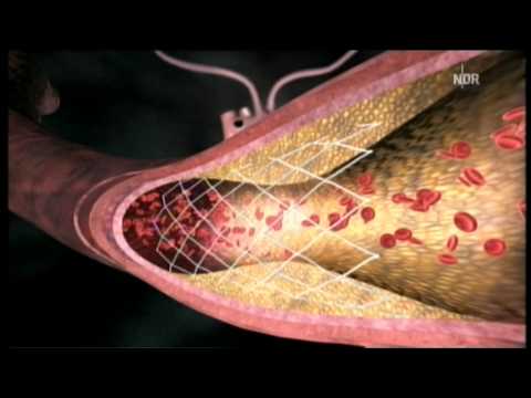Die Symptome der Candidiasis bei Patienten mit Diabetes Ob es möglich ist, die Lippen in Diabetes zu machen