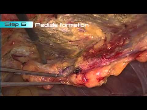 Internal Thoracic Artery (ITA) Harvesting