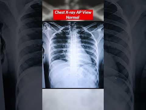Chest X-ray Normal vs Fracture ⚡️Ribs Fracture #chestxray #xray #fracture #bones