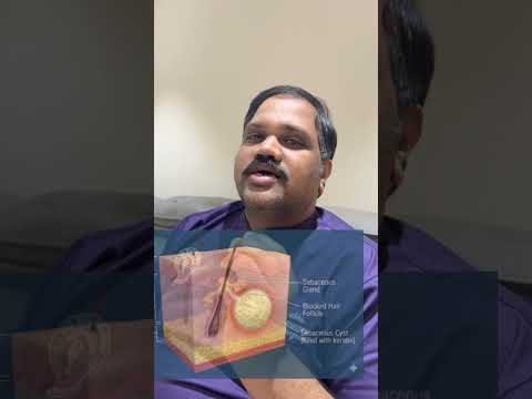 Sebaceous cyst minimal scar removal short video thumbnail by Dr. Ram Prabhu.