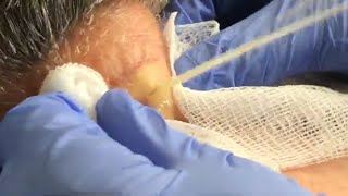 Large Cyst Squirts and Oozes from Patient
