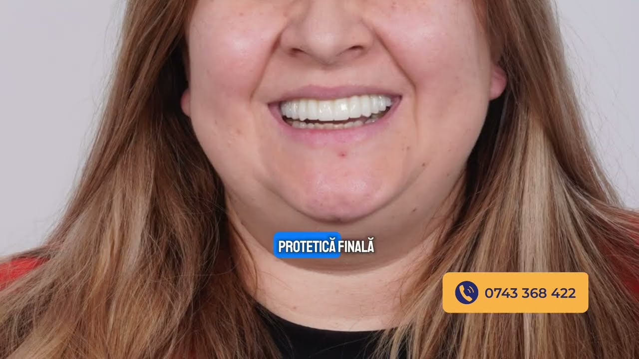 <div style="text-align: left; white-space: normal; overflow: hidden; display: -webkit-box; -webkit-line-clamp: 2; -webkit-box-orient: vertical; line-height: 1.3em;">Zâmbet Recuperat cu Dantură Fixă pe Implanturi | Povestea Unui Caz clinic Dentville</div>