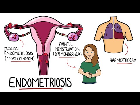 Endometriosis Explained (Signs & Symptoms, Diagnosis, Pathology, Treatment)