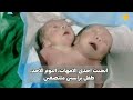 مفاجأة..أم تنجب طفل برأسين ملتصقين في زبيد اليمن..