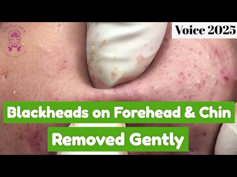 Blackheads on Forehead & Chin Removed Gently – And Something Deeper Came Out ( Voice) |Pimple Spa