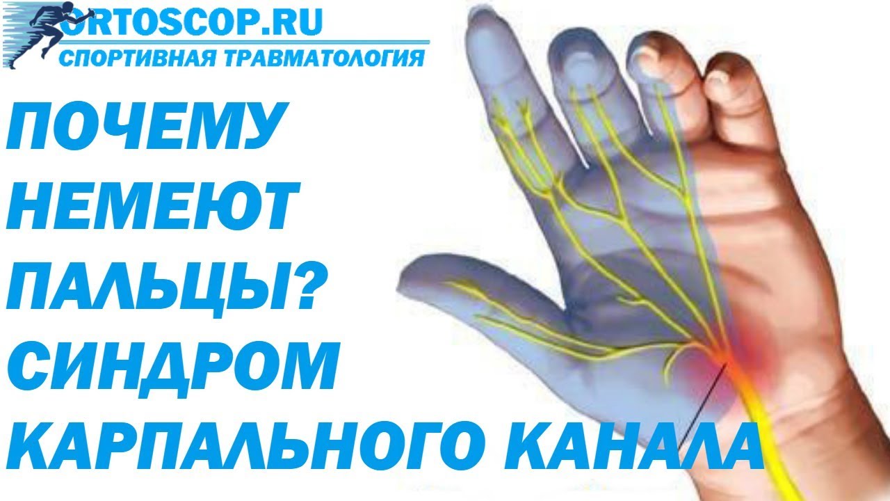 СИНДРОМ КАРПАЛЬНОГО КАНАЛА. СДАВЛЕНИЕ СРЕДИННОГО НЕРВА
