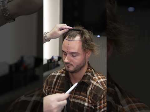 Cosmedica Clinic Hair Transplant in Turkey #shorts #hairtransplant #video