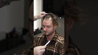 Cosmedica Clinic Hair Transplant in Turkey #shorts #hairtransplant #vi