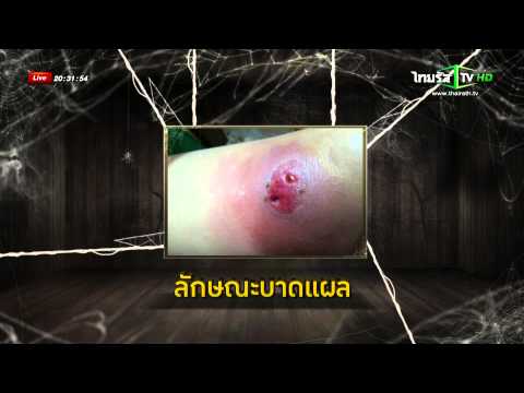 คนเล็กกระเจี๊ยว 1000 ความแรง homeopathy