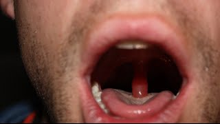 swollen throat: clinical case answer and discussion