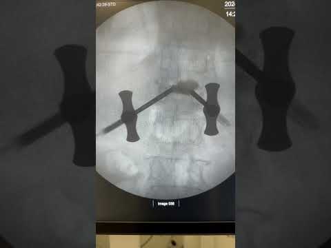 How is Spine vertebroplasty kyphoplasty done? 