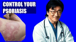 Top 5 Tips to Control Psoriasis Flare Ups