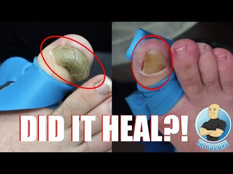 RAM'S HORN TOES WITHOUT TOENAILS...WEIRD OR NO??? FOOT HEALTH MONTH 2018 #16 Video