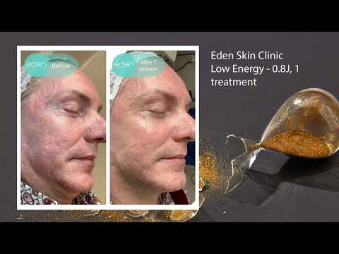 Strictly before & after NeoGen treatments