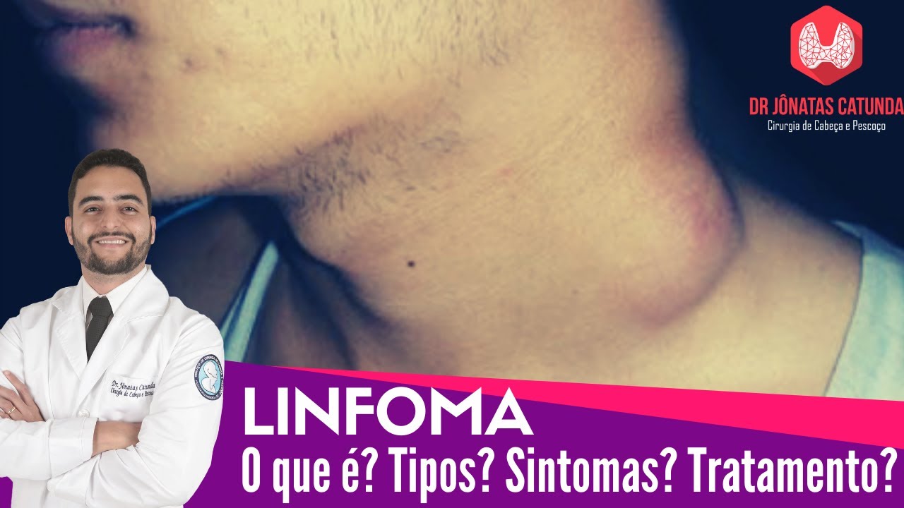 O que é Linfoma? Tipos de linfoma, Sintomas, Tratamento - Dr Jônatas Catunda