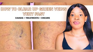 HOW TO CLEAR UP GREEN VEINS VERY FAST: Causes & Treatments + Best Products To Get Rid Of Green veins