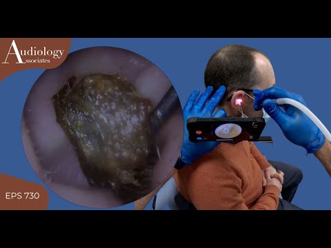 EPIC EAR WAX REMOVALS - WITH PATIENT VIEW - EP730