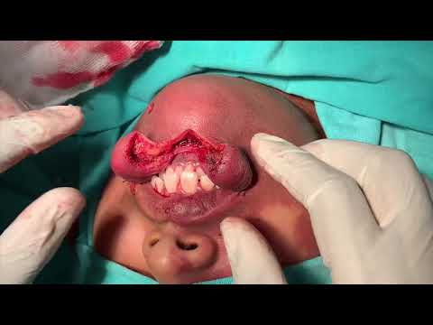 Cavernous Lower Lip Hemangioma Surgery