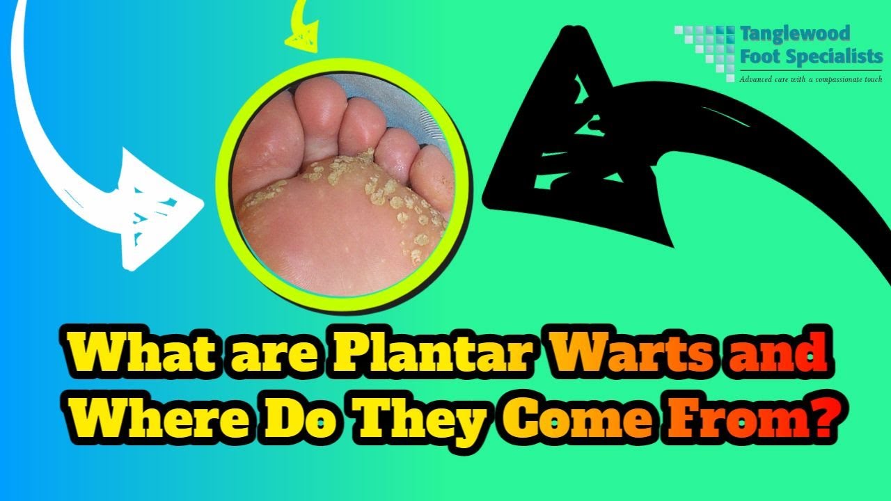 What are Plantar Warts and Where Do They Come From?