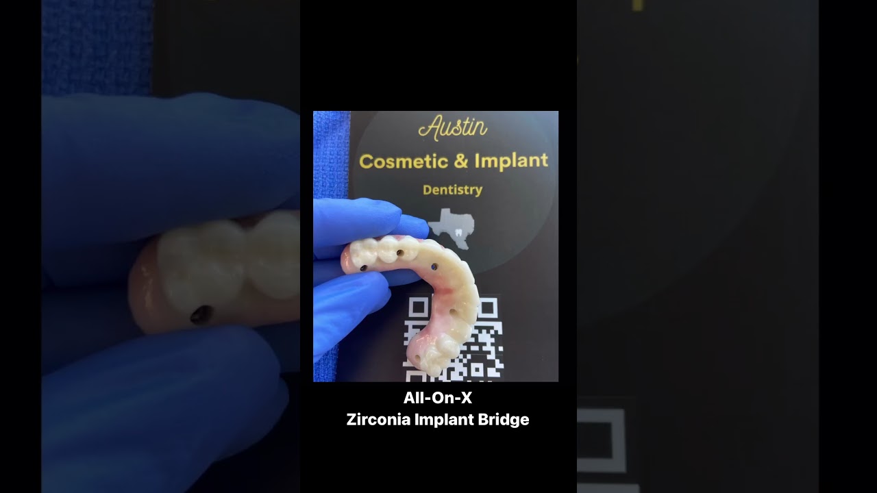 All On X - Zirconia Implant Bridge