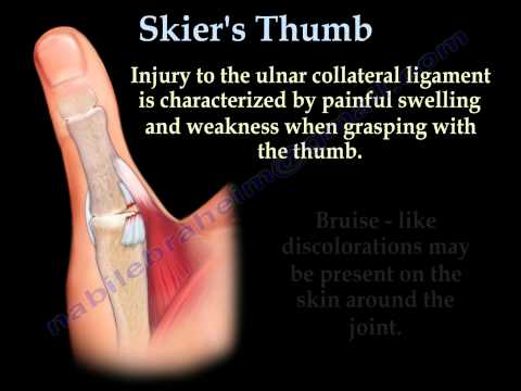 Skier's Thumb Gamekeeper's Thumb - Everything You Need To Know - Dr. Nabil Ebraheim