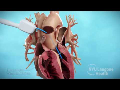 Septal Myectomy and Residual Leaflet Excision for Hypertrophic Cardiomyopathy