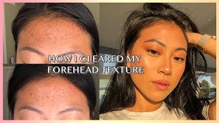HOW TO REALLY GET RID OF FOREHEAD ACNE / TEXTURE | Christine Le