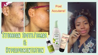 REAL Tips to FADE SCARS & SPOTS | HYPERPIGMENTATION | No more SKIN PICKING