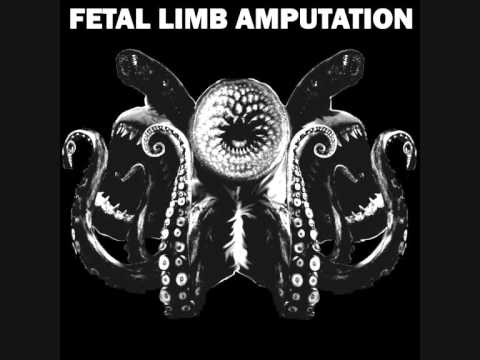 Fetal Limb Amputation - The offending article.wmv
