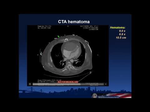 COMPLICATION BOOTCAMP: MY WORST COMPLICATION - Kendrick Shunk, MD