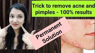 How to remove Acne/pimples after pregnancy !! How to get rid of acne permanently