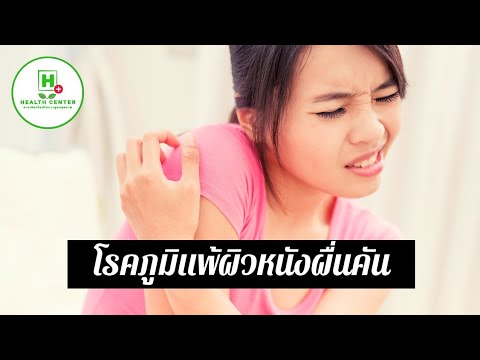 ย้อมผมมีโรคสะเก็ดเงิน การรักษา afobazol ของโรคสะเก็ดเงิน
