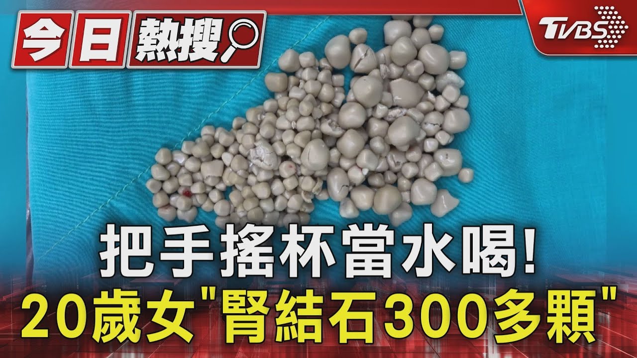 把手搖杯當水喝！20歲妙齡女「腎結石300多顆」