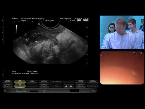 Fall 09   Nekrotisierende Pankreatitis