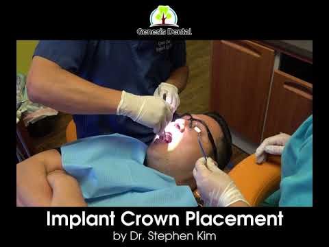 [Genesis Dental] Implant Crown Placement by Dr Stephen Kim