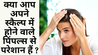 How Do I Stop Pimples On My Scalp | Causes of Acne On Scalp | How To Cure Pimples On Scalp |