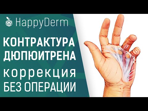 Лечение контрактуры Дюпюитрена, коррекция ладонного апоневроза малоинвазивным методом
