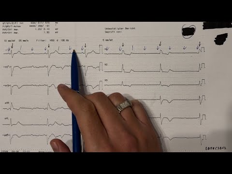 Synkope und AV-Block: Ein Fallbericht und seine Lösung